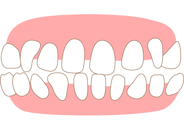 すきっ歯 空隙歯列・正中離開