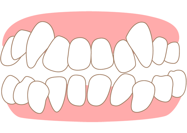 ガタガタの歯並び 叢生