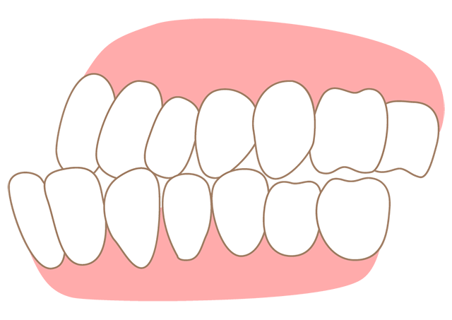 下顎が上顎より前に出ている 下顎前突