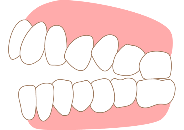 前歯がかみ合っていない 開咬
