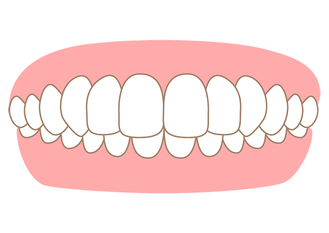 かみ合わせが深すぎる 過蓋咬合
