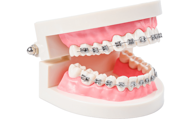 ブラケット矯正（表側矯正）